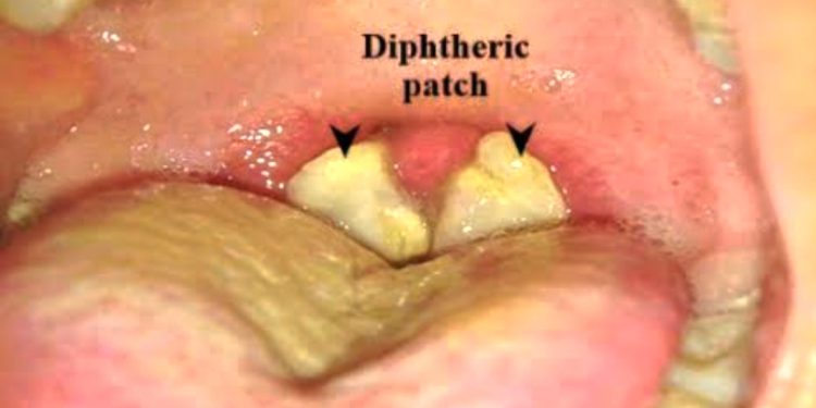 NCDC raises red flag on spread of diphtheria