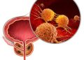 Prostate cancer