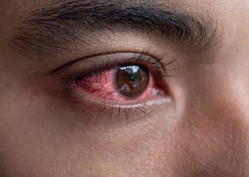 Tanzania issues high alert over red eye disease outbreak
