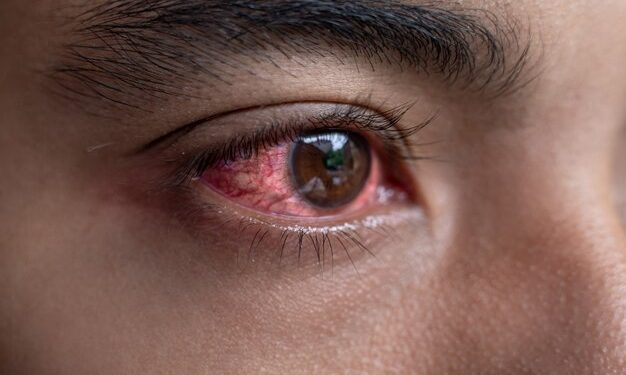 Tanzania issues high alert over red eye disease outbreak