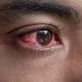 Tanzania issues high alert over red eye disease outbreak