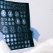 First human receives brain implant from Elon Musk’s Neuralink