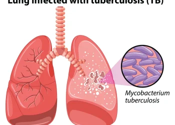 Tuberculosis cases peak at 300,000, says Health Minister Pate