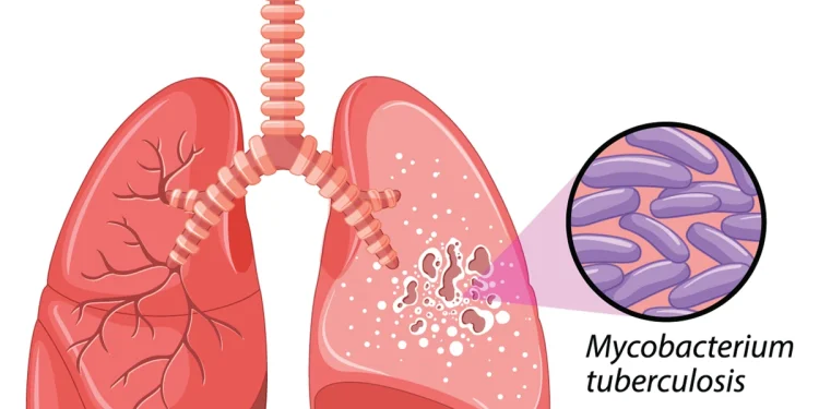 Tuberculosis cases peak at 300,000, says Health Minister Pate