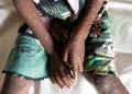 NCDC : Monkey pox cases in Nigeria decline