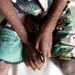 Sweden records first case of Monkey Pox