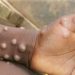 Gavi secures 500,000 Mpox vaccines to combat deadly outbreak in Africa