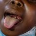 Diphtheria kills 1,191 persons in 17 months in Nigeria, NCDC
