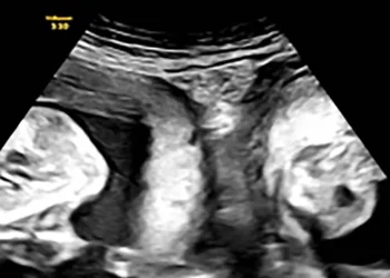 Woman with two uteruses gives birth to twins in China