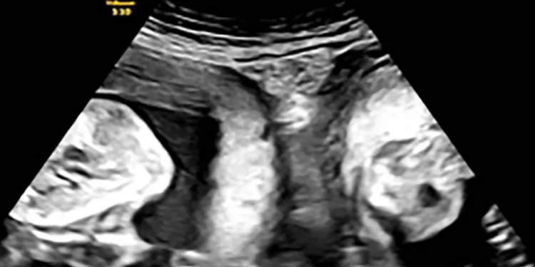 Woman with two uteruses gives birth to twins in China