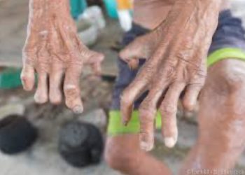 WHO delivers leprosy drugs to Nigeria