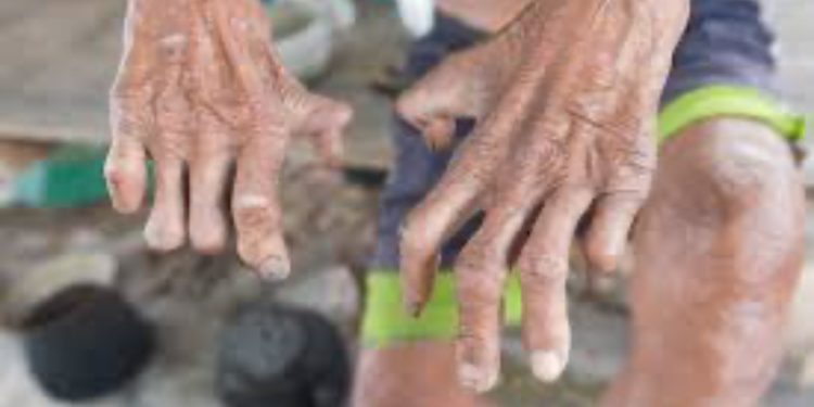 WHO delivers leprosy drugs to Nigeria