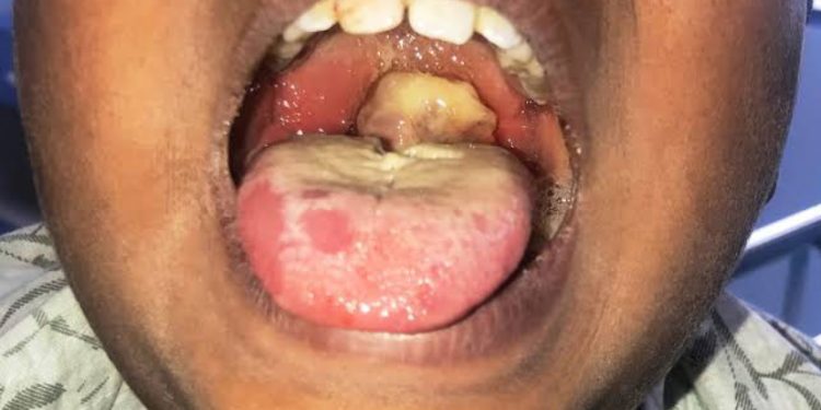 Diphtheria outbreak leads to death, hospitalizations at King’s College