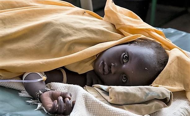 A South Sudan child suffering from Cholera. [PHOTO CREDIT: CIDRAP]