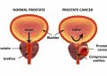 Urine test, AI offer hope in prostate cancer fight