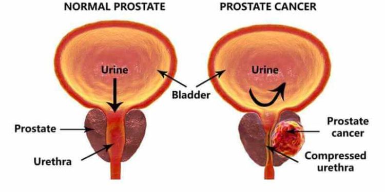 Urine test, AI offer hope in prostate cancer fight
