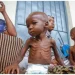 FG, partners commit $30m to tackle child malnutrition