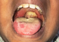 A Diphtheria patient