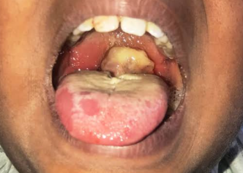 A Diphtheria patient