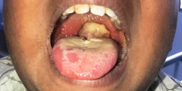 A Diphtheria patient