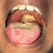 A Diphtheria patient