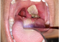 A medical image shows a thick, grayish-white pseudomembrane covering the tonsillar and throat region, a characteristic clinical feature associated with respiratory diphtheria, as health officials urge Nigerians to strengthen vaccination and seek early treatment to prevent complications and deaths.