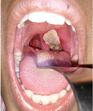 A medical image shows a thick, grayish-white pseudomembrane covering the tonsillar and throat region, a characteristic clinical feature associated with respiratory diphtheria, as health officials urge Nigerians to strengthen vaccination and seek early treatment to prevent complications and deaths.