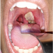 A medical image shows a thick, grayish-white pseudomembrane covering the tonsillar and throat region, a characteristic clinical feature associated with respiratory diphtheria, as health officials urge Nigerians to strengthen vaccination and seek early treatment to prevent complications and deaths.