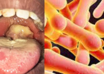 Diphtheria