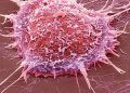 Microscopic view of cancer cells linked to infection-related cancer research.