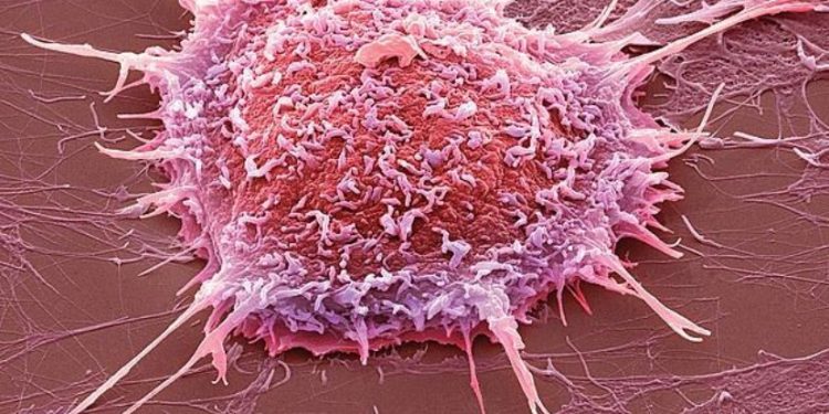 Microscopic view of cancer cells linked to infection-related cancer research.